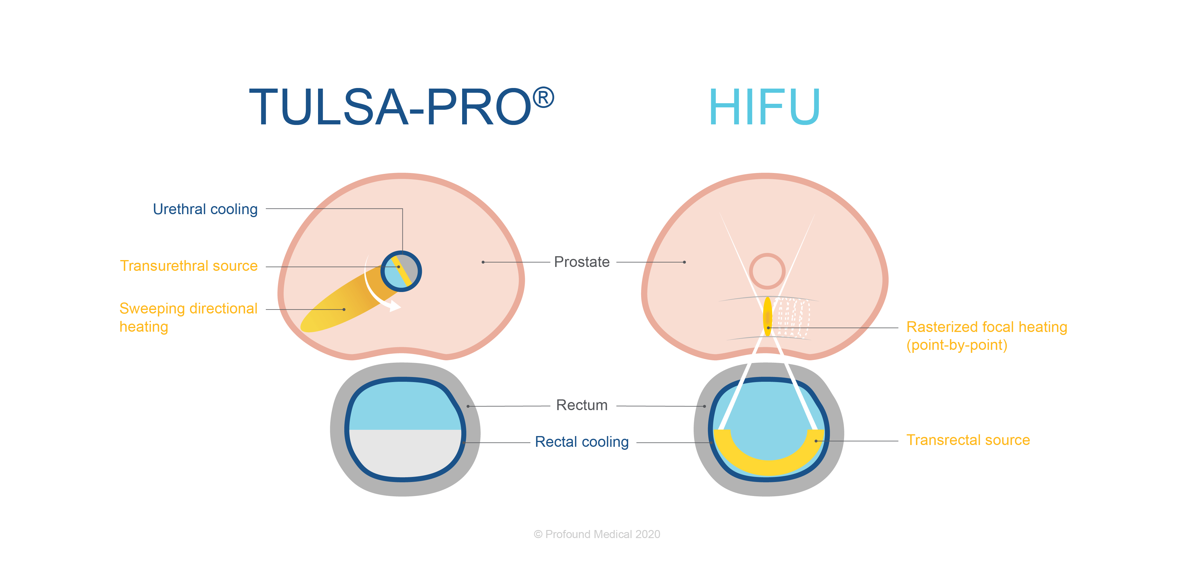 TULSA vs HIFU