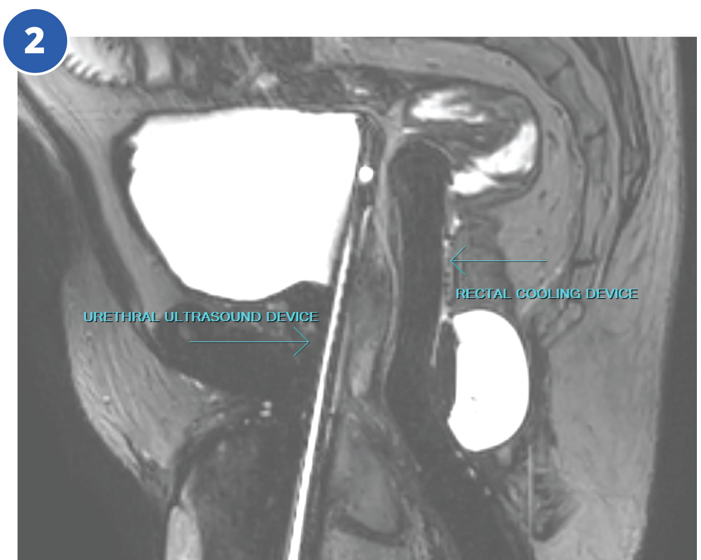 Prostate TULSA Procedure Case Study